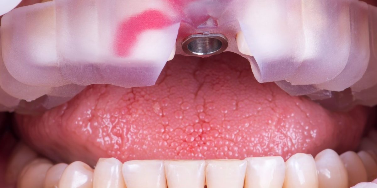Implantes dentales con cirugía guiada