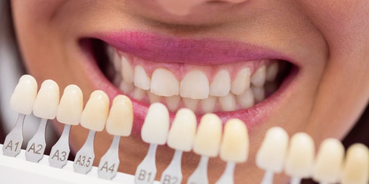 ¿Qué precio tienen las carillas dentales?