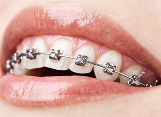 brackets de autoligado barcelona