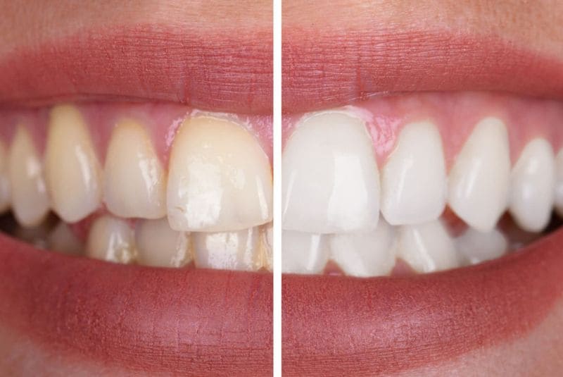 Blanqueamiento dental barcelona