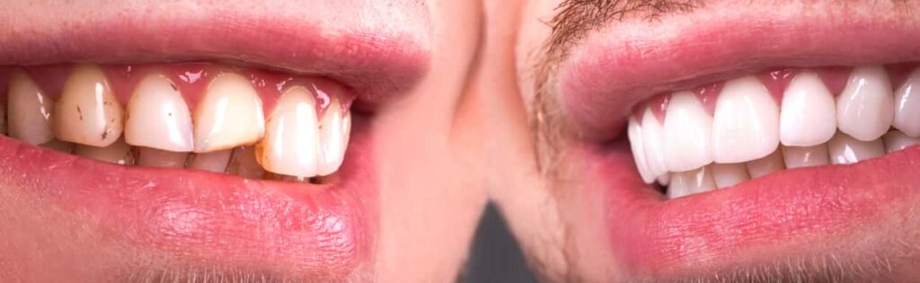 manchas en los dientes