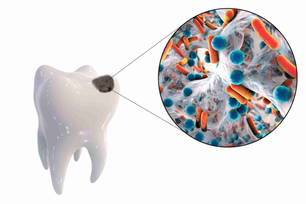 manchas negras en los dientes