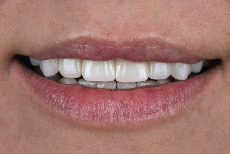 Carillas de Disilicato de Litio​