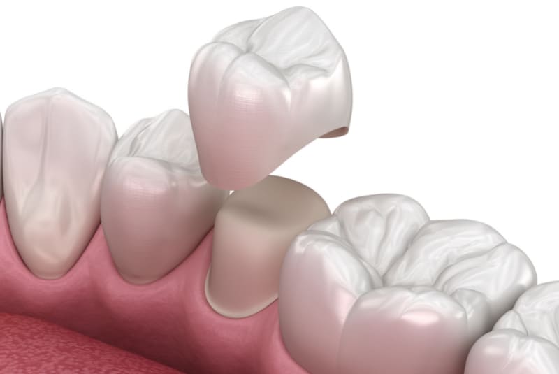 carilla dental de composite ejemplo