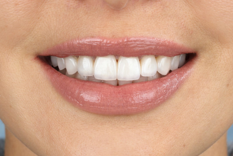 carillas dentales de composite