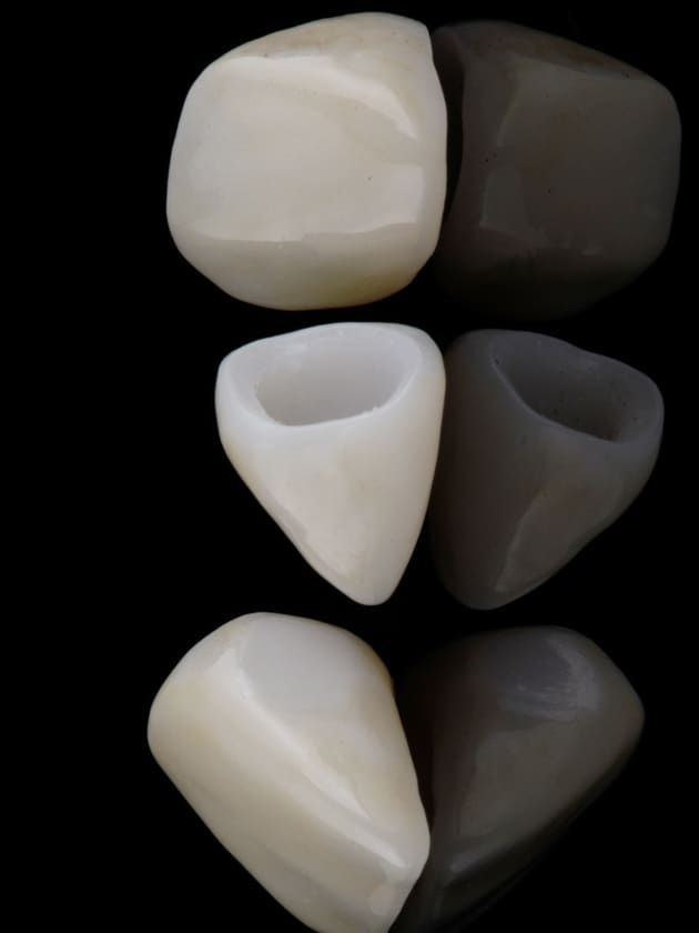carillas dentales de porcelana