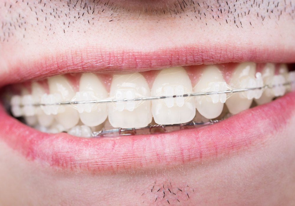 Brackets de cerámica