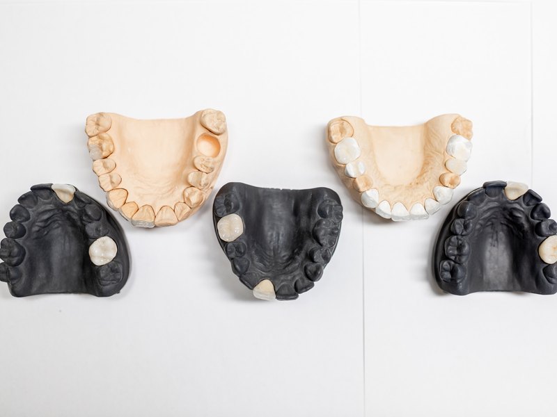 Cinco modelos de escayola de arcadas dentales con dientes de porcelana en distintos tonos