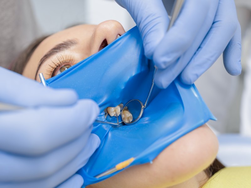 Dentista retirando un empaste antiguo de amalgama con aislamiento de dique