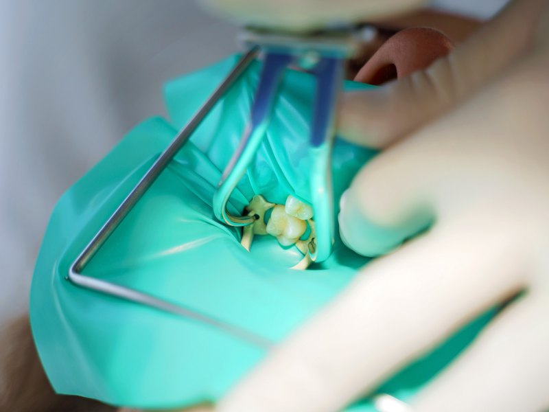 Dentista retirando un empaste antiguo de amalgama con aislamiento de dique