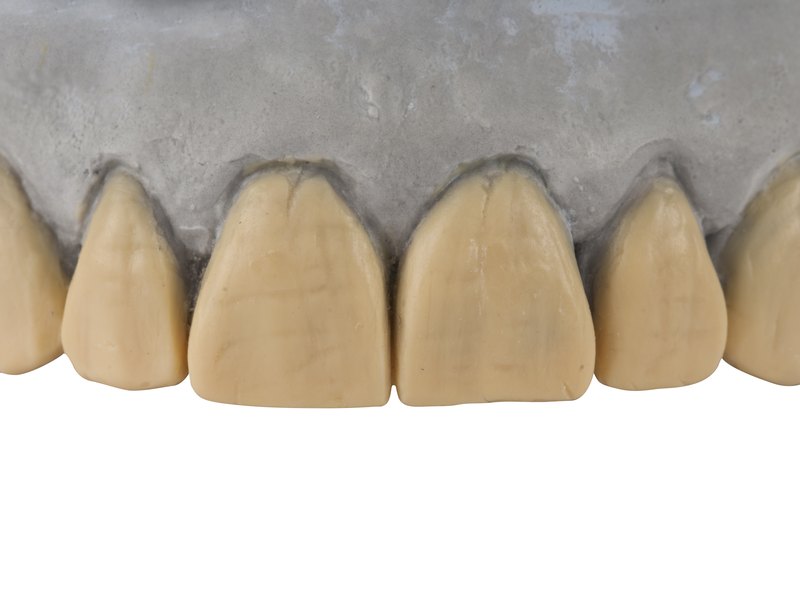 Cream and beige ceramic or composite dental crowns
