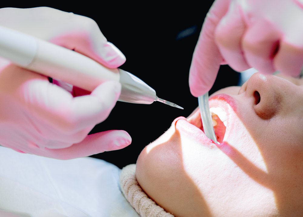 Limpieza bucal profesional: retirada del sarro con un raspador ultrasónico