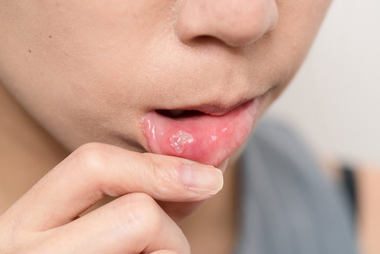 Mujer mostrando una llaga en la cara interna del labio inferior