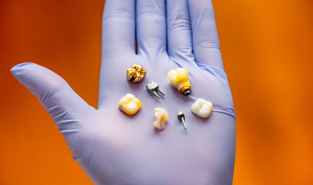 Gloved hand holding dental implants and crowns
