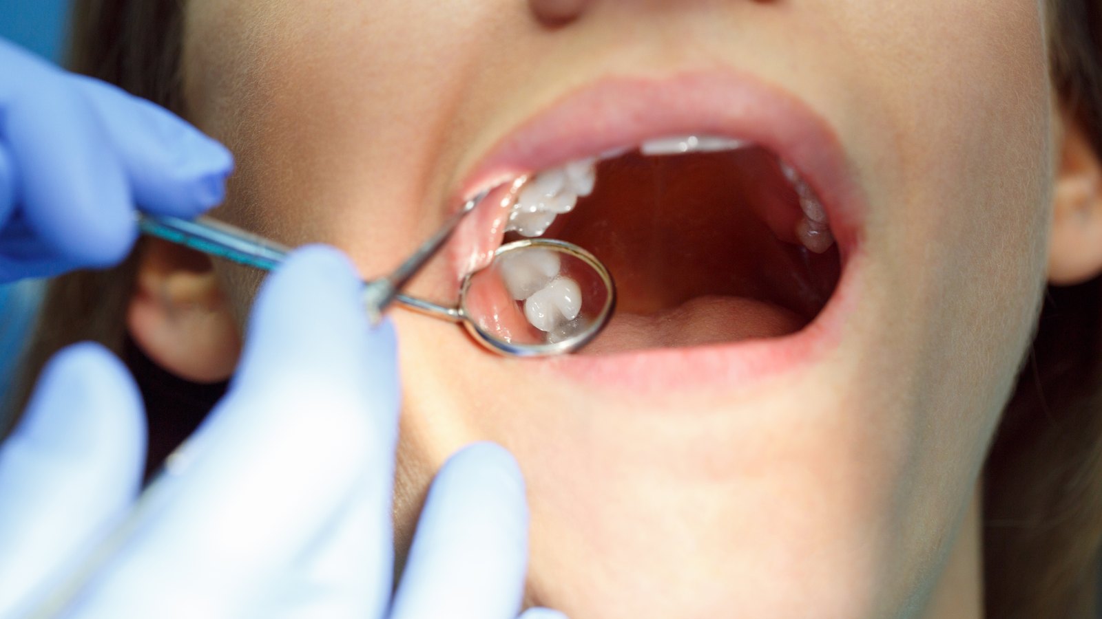 Dentista revisando con un espejo la muela rota de una paciente en la consulta, antes de decidir entre empaste y reconstruccion