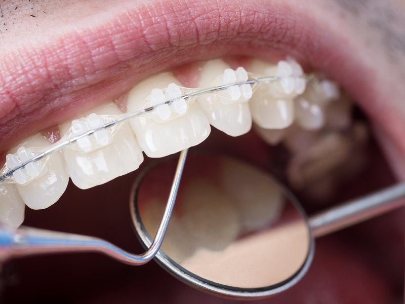 Patient's mouth with orthodontic appliances fitted