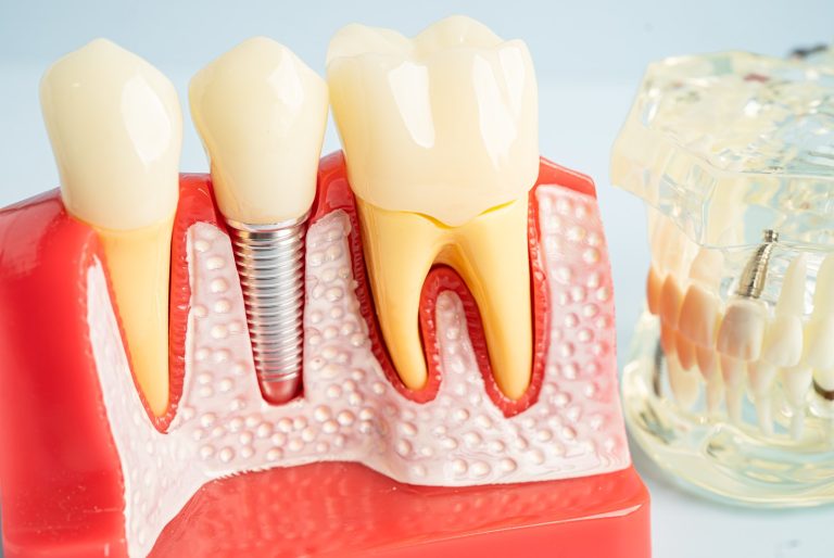 Dental model with a titanium implant in the bone and gum next to natural teeth