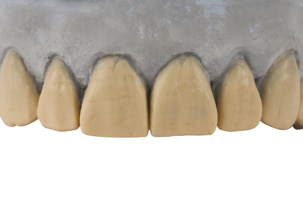 Piezas de cerámica dental vistas de cerca