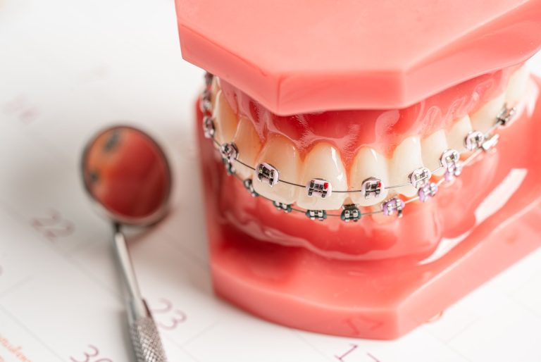 Modelo dental con brackets metálicos y arco de ortodoncia junto a un espejo dental