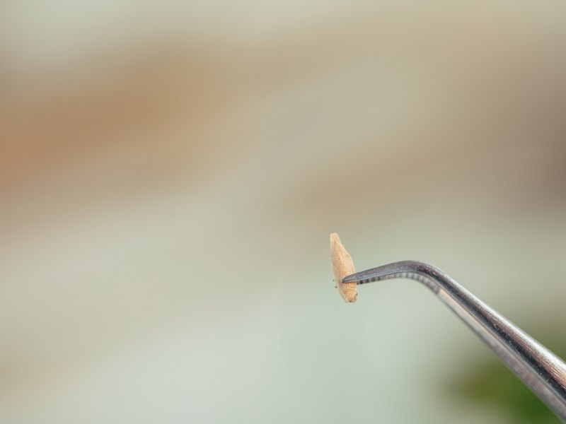 Dental veneer held with tweezers before placement