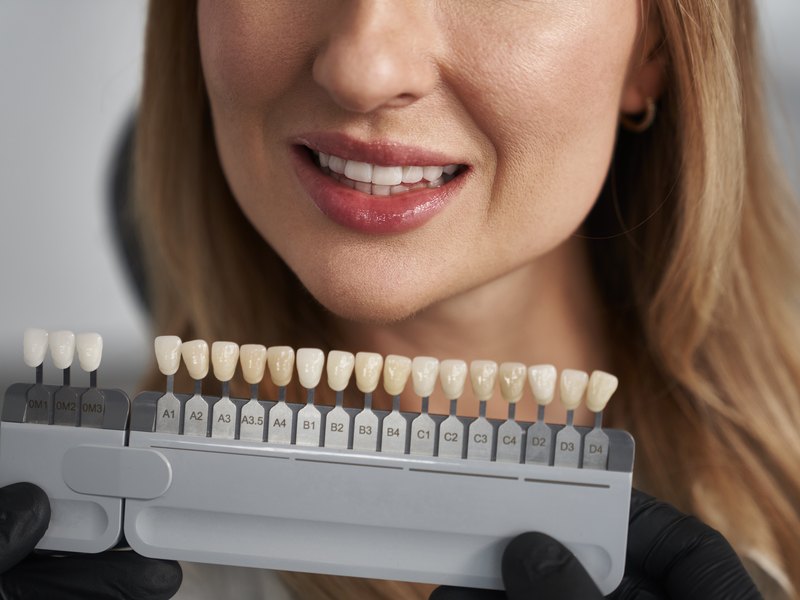 Close-up of a smile with the shade guide showing the colour comparison and the reference codes