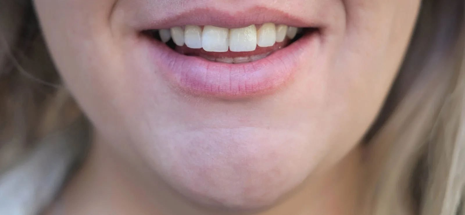 Sonrisa de una mujer con los labios entreabiertos, consulta de blanqueamiento dental con fluorosis en Barcelona
