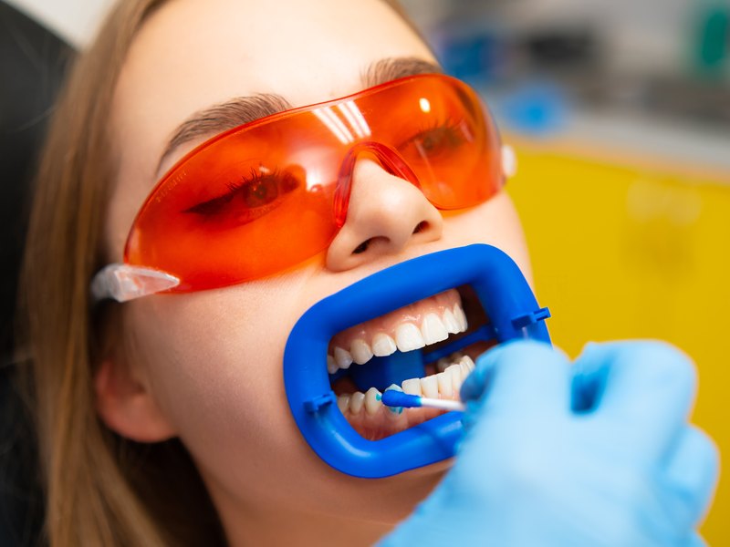 Dentista aplicant gel blanquejador a una pacient amb separador bucal i ulleres de protecció