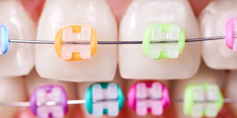 Close-up of clear braces with colored elastics on the upper and lower teeth