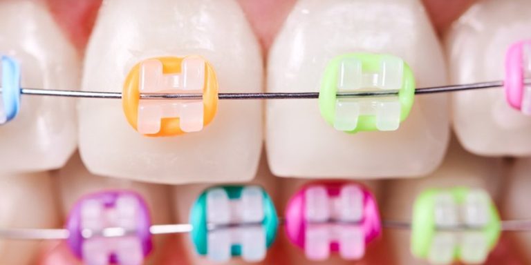 Brackets con gomas de colores en los dientes de arriba y de abajo, vistos de cerca