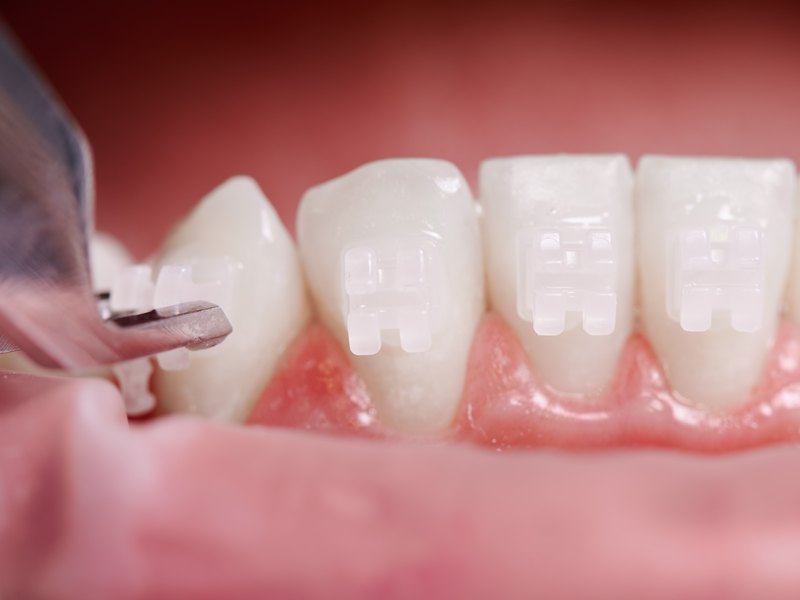 Fitting white ceramic braces onto the lower teeth