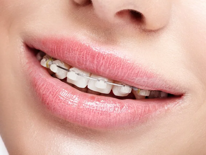 Labios de una mujer que dejan ver brackets estéticos del color del diente, ortodoncia discreta en Barcelona