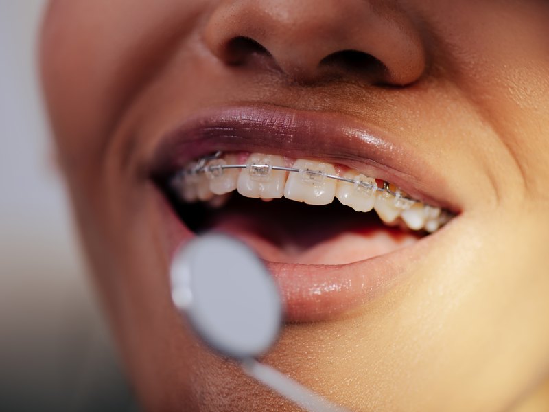 Primer pla de dents amb brackets per corregir-ne la posició i un mirall dental