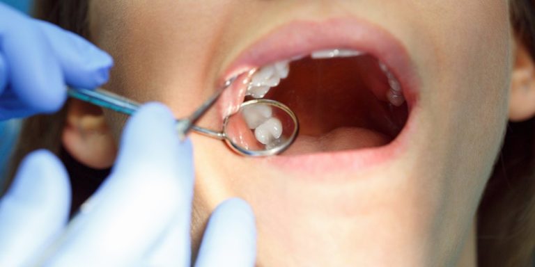 Dentist examining a broken tooth with a dental mirror