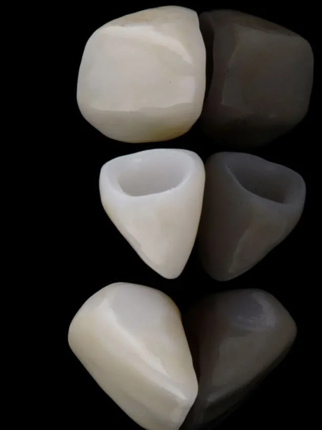 Seis carillas de porcelana sobre fondo negro, vistas con luz y a contraluz, en una clínica de Barcelona