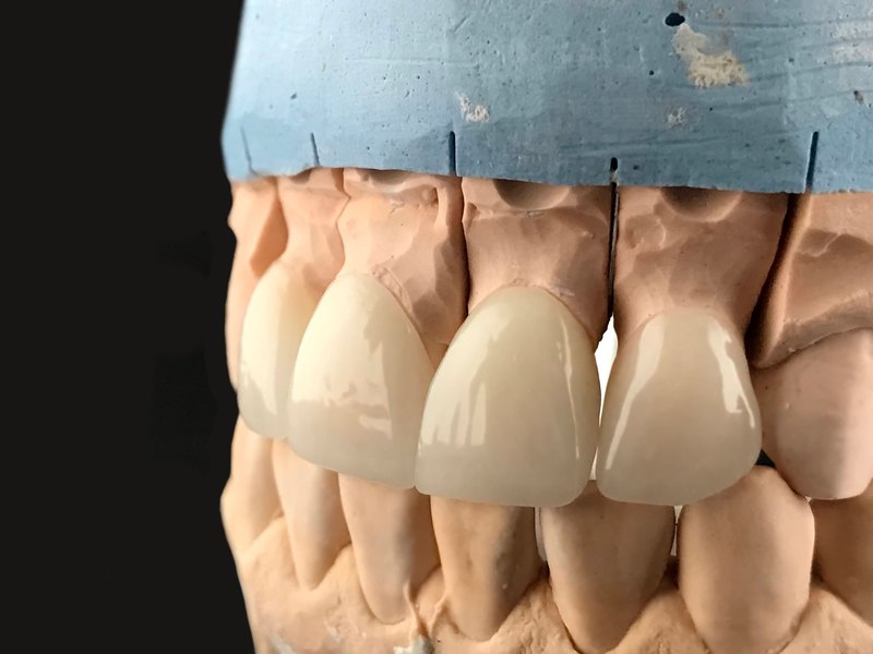 Porcelain veneers placed on a plaster model of the upper teeth