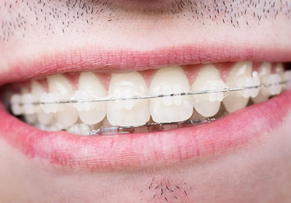 Man smiling with tooth-coloured ceramic braces and a thin metal archwire, orthodontics in Barcelona