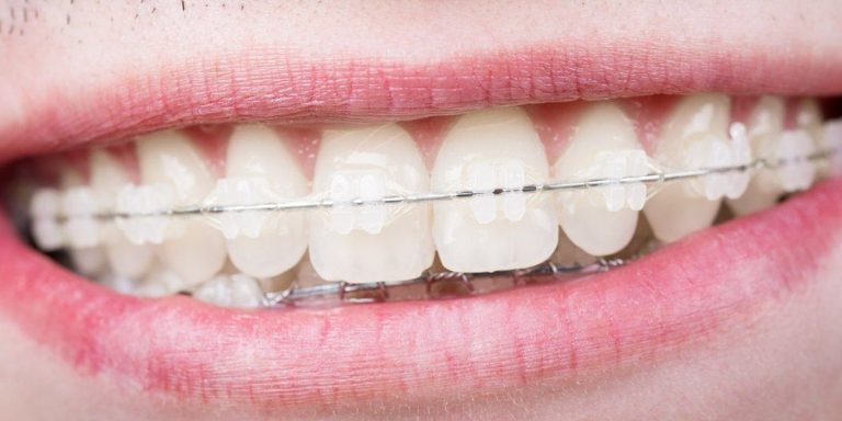 Smile with clear ceramic braces on the upper teeth and the thin metal wire that joins them