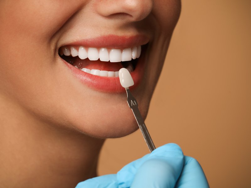 Mostra de color de la guia de tons al costat de les dents abans d'un blanquejament