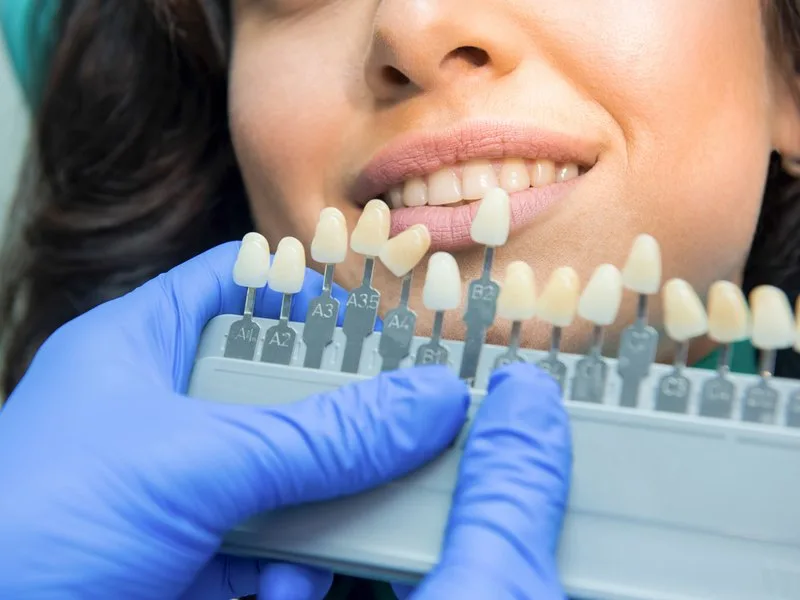 Dentista comparando el color de los dientes de una paciente con una guía de tonos