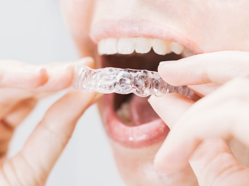 Persona que es col·loca un retenidor transparent a les dents de dalt