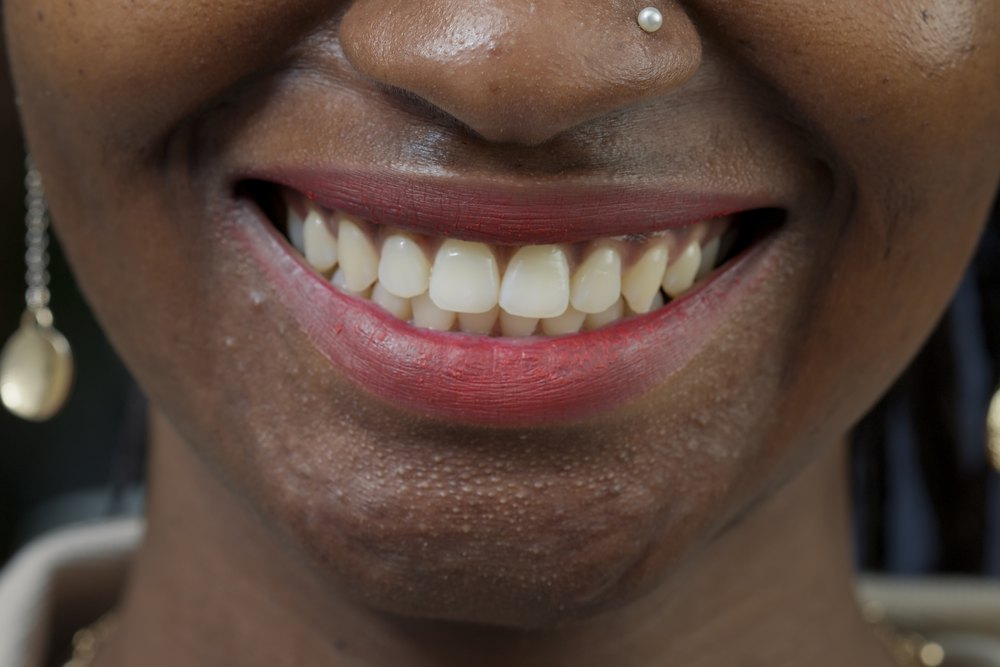 Gingival smile