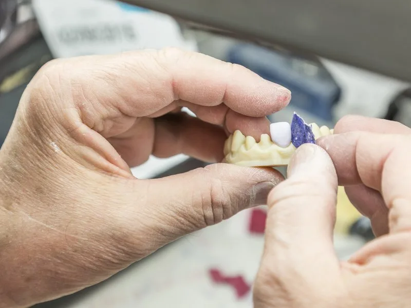 Dental technician's fingers holding a stone model with a ceramic crown, a common dental crown type in Barcelona