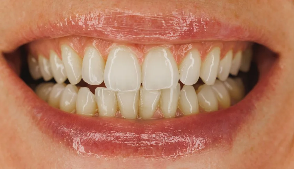 Smile with even white teeth, without the spots left by dental fluorosis, in Barcelona