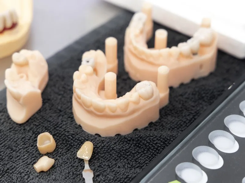 Printed dental models with posts, loose crowns and a shade tab on a lab tray showing dental prosthesis types in Barcelona