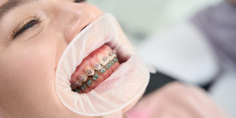 Primer pla de dents amb brackets metàl·lics i separador de llavis a la consulta
