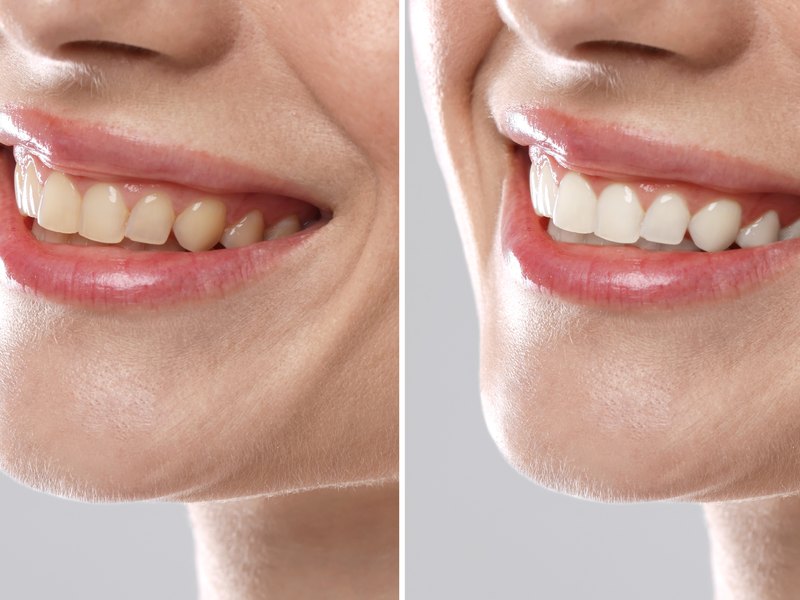 Sonrisa con dientes amarillentos antes del blanqueamiento y la misma sonrisa después