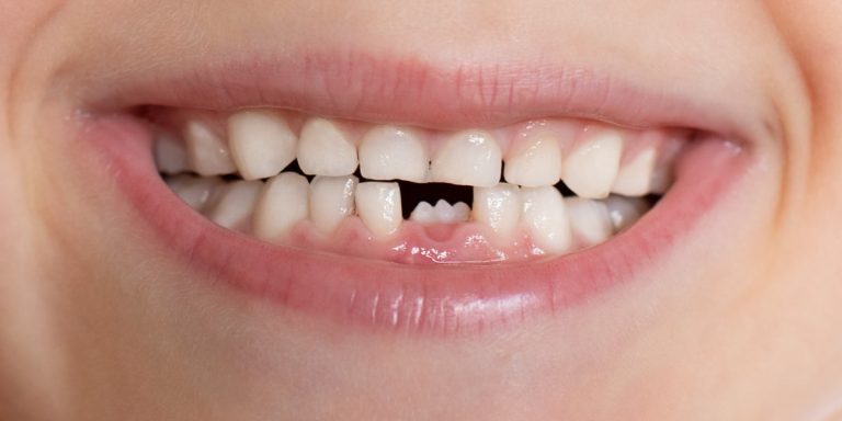 Sonrisa de un niño con el hueco de un diente de leche y el definitivo asomando