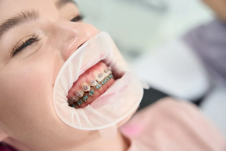 Mujer con separador de labios y brackets metálicos en la consulta, tratamiento de dientes torcidos en Barcelona