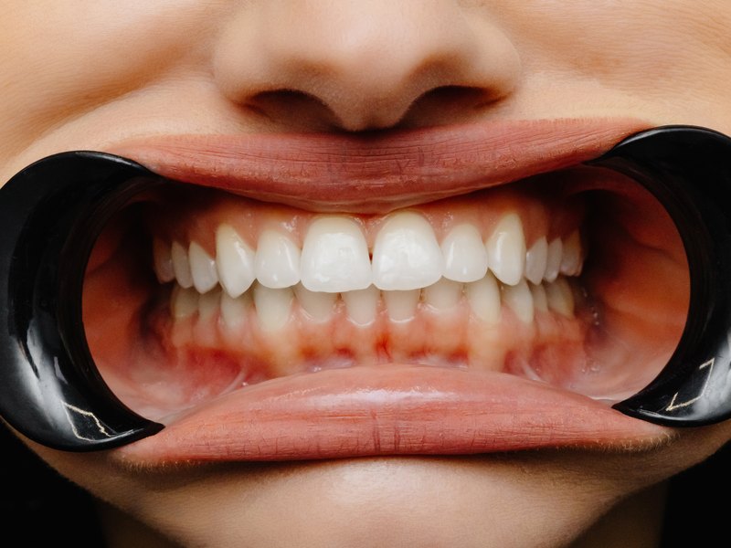 Close-up of teeth with a cheek retractor and reddened gum margins