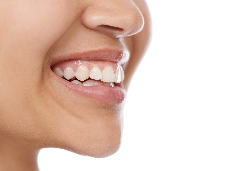 Smile in profile with a strip of pink gum showing above the upper teeth